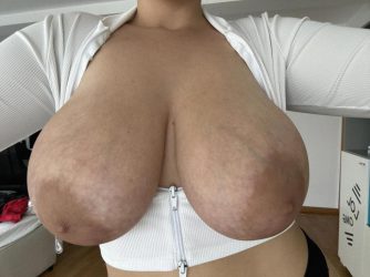 Chichotas venosas de una señora